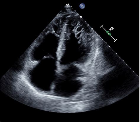 mildly reduced lv ejection fraction|echocardiogram 55 to 60.